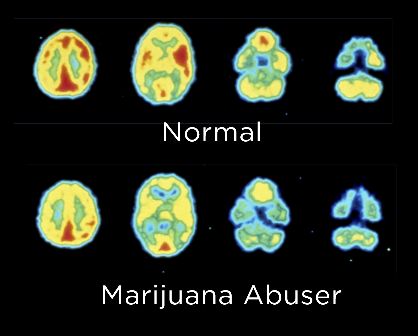 How marijuana affects your brain