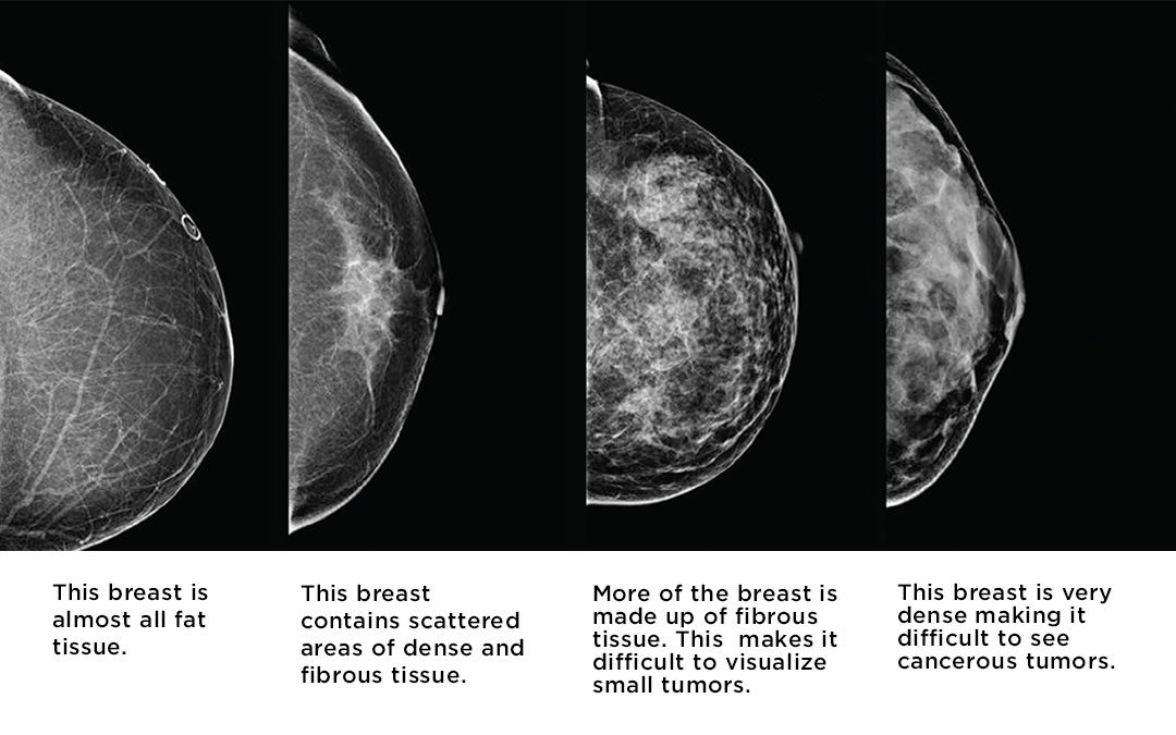 Mammogram or ultrasound or both?